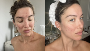 Before and after photos of a woman's face showing the improvement in acne after using Hybrid Tanning for treatment