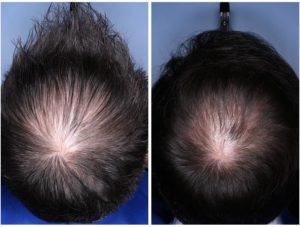 Before and After Hair Growth with Red Light Therapy